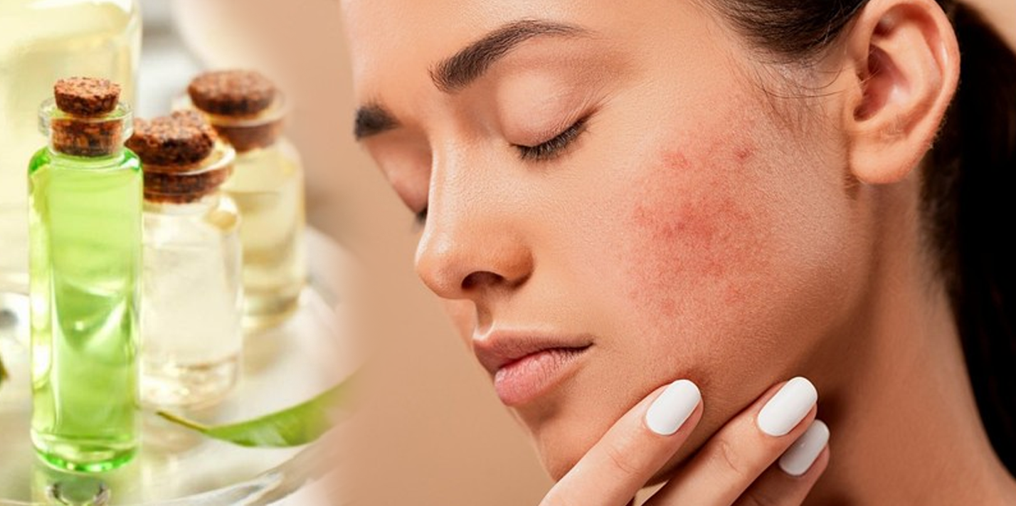 4 Obat Herbal Alami Ini Dapat Membantu Atasi Masalah Kulit